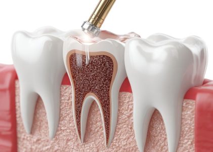 Ključ do zdravih dlesni in dolgotrajnega nasmeha z luščenjem in glajenjem zobnih korenin